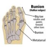 Lábujjak elválasztó zokni Hüvelykujj-beállító Hajegyenesítő Láb Csont Ortózis Készülék Hallux Valgus Sínhüvely Bunion Corrector